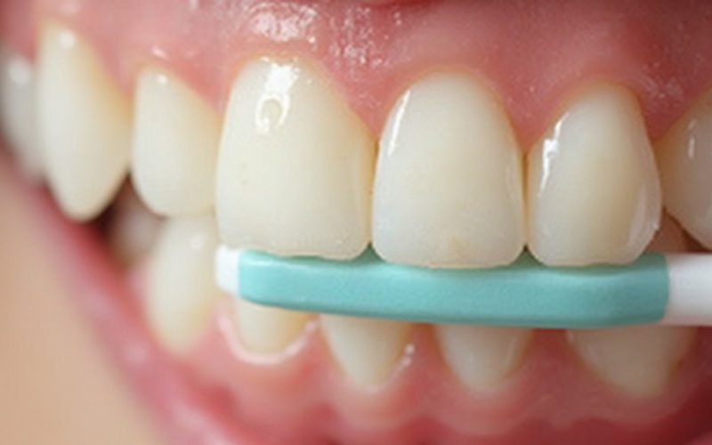 brushing habits lead to discoloration