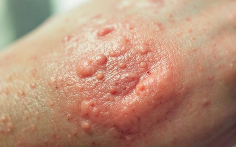 insulin related neck lesion