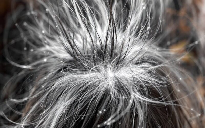 stress causes hair loss