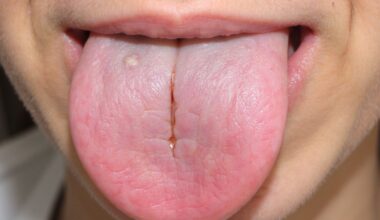 tongue cracks indicate health
