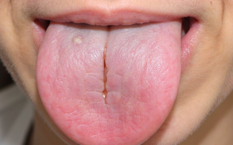 tongue cracks indicate health
