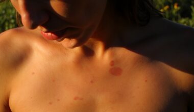 moles at risk from sun