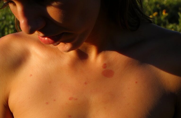 moles at risk from sun