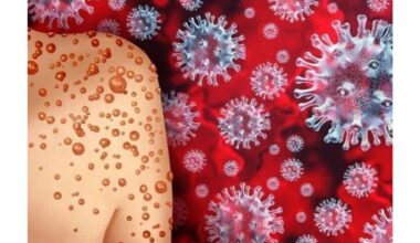 beždžionių raupai skiriasi nuo Covid