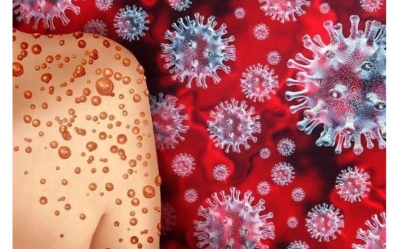 beždžionių raupai skiriasi nuo Covid