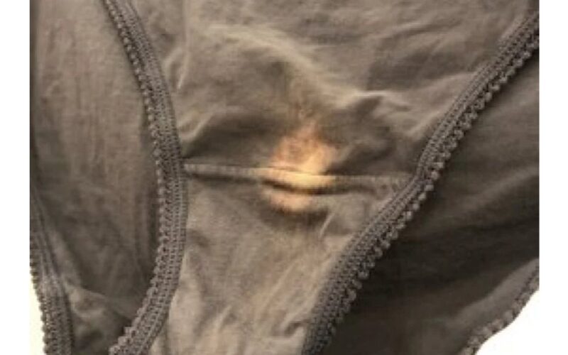 balti lopeliai ant vulvos