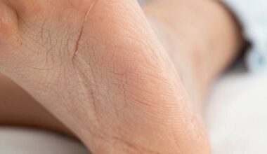 pažiūrėkite į savo kulnus, jei įtrūkę