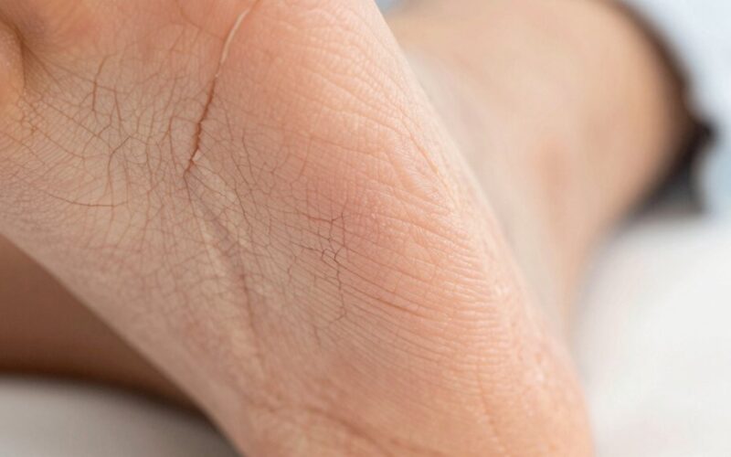 pažiūrėkite į savo kulnus, jei įtrūkę