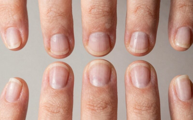 nagų pakitimai rodo ligą