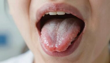 liežuvio tinimas atminties praradimas