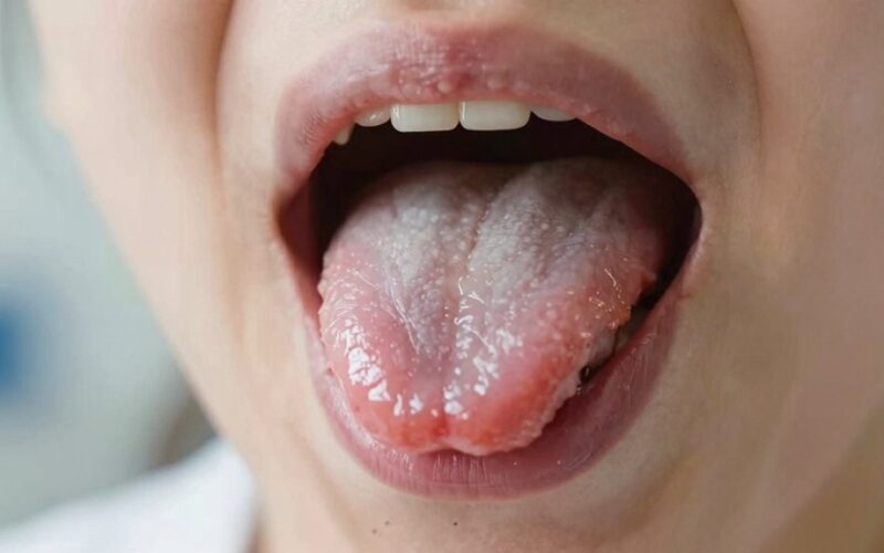 liežuvio tinimas atminties praradimas