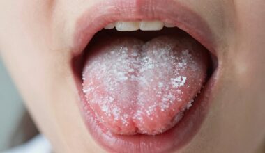 balta danga liežuvyje paaiškinta