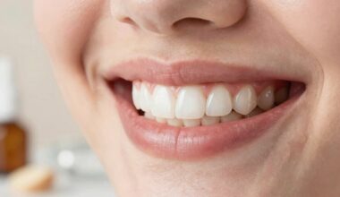 balinimas dantų namuose