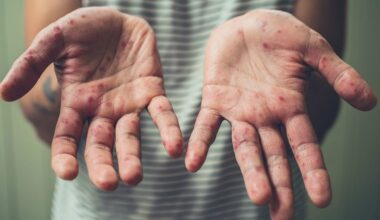 vengti Koksakie viruso infekcijos