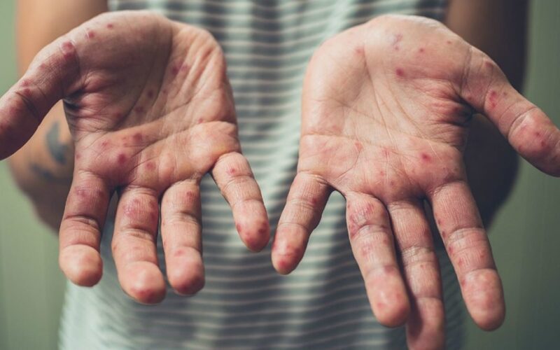 vengti Koksakie viruso infekcijos