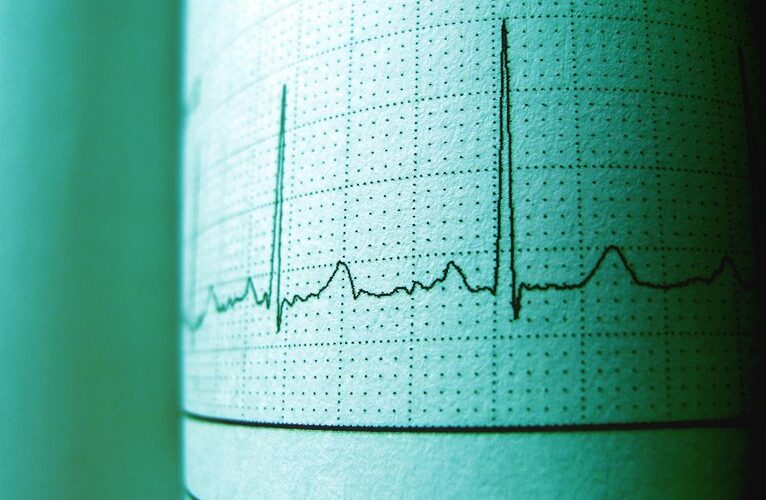 lėtas širdies ritmas tikrinti magnį